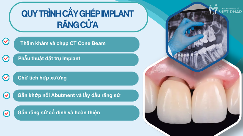 Quy trình cấy ghép Implant răng cửa