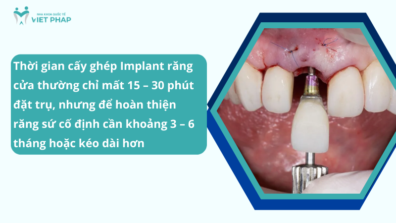 Thời gian cấy ghép Implant răng cửa thường chỉ mất 15 – 30 phút đặt trụ, nhưng để hoàn thiện răng sứ cố định cần khoảng 3 – 6 tháng hoặc kéo dài hơn