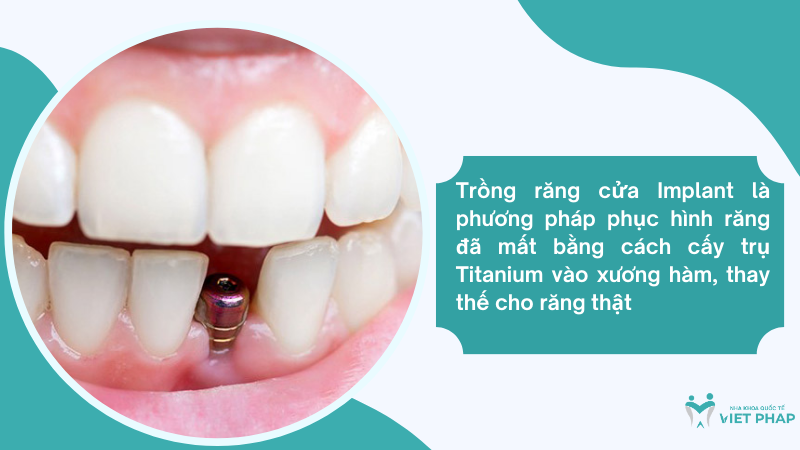 Trồng răng cửa Implant là phương pháp phục hình răng đã mất bằng cách cấy trụ Titanium vào xương hàm, thay thế cho răng thật