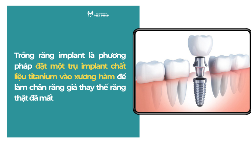 Trồng răng implant là phương pháp đặt một trụ implant chất liệu titanium vào xương hàm để làm chân răng giả thay thế răng thật đã mất