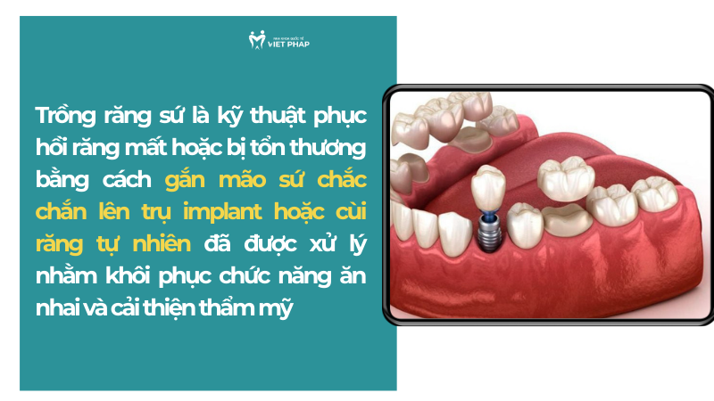 Trồng răng sứ là kỹ thuật phục hồi răng mất hoặc bị tổn thương bằng cách gắn mão sứ chắc chắn lên trụ implant hoặc cùi răng tự nhiên đã được xử lý nhằm khôi phục chức năng ăn nhai và cải thiện thẩm mỹ