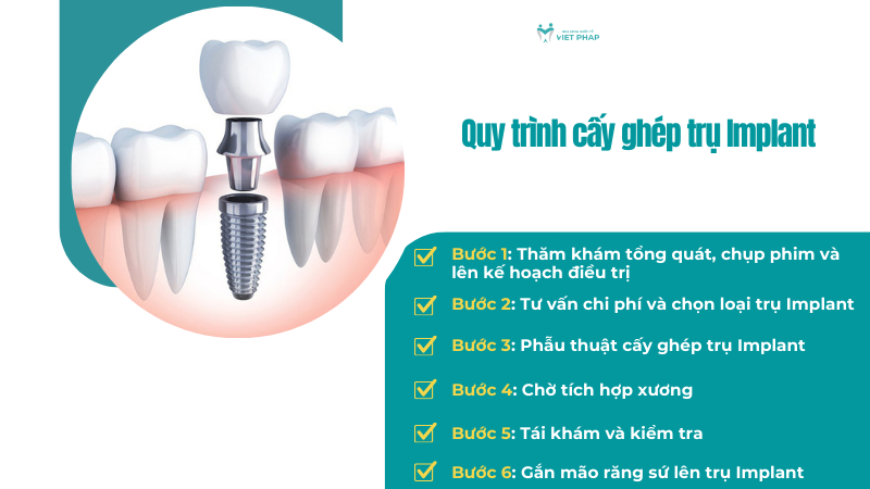 Quy trình cấy ghép trụ Implant 