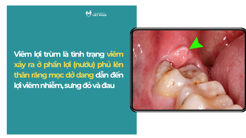 Viêm lợi trùm là tình trạng viêm xảy ra ở phần lợi (nướu) phủ lên thân răng mọc dở dang dẫn đến lợi viêm nhiễm, sưng đỏ và đau