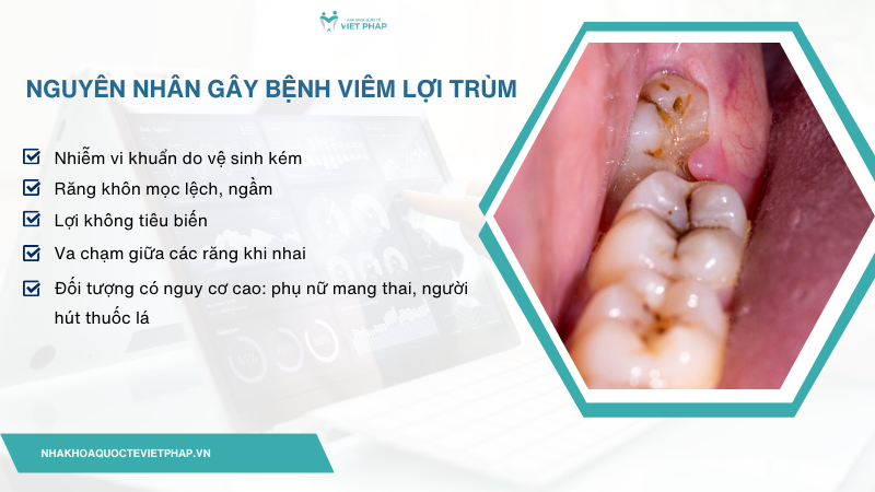 Nguyên nhân gây bệnh viêm lợi trùm 