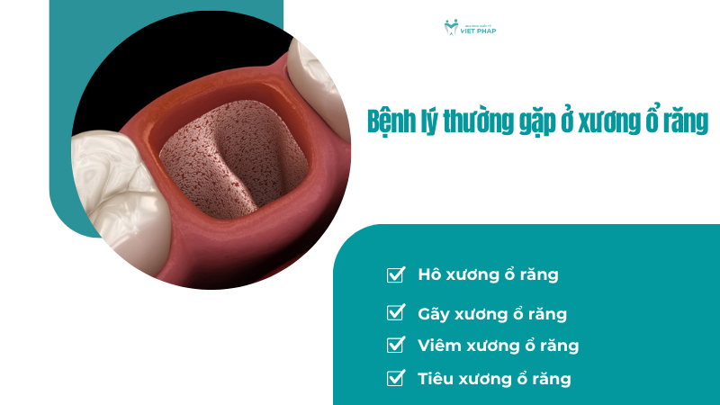 Bệnh lý thường gặp ở xương ổ răng