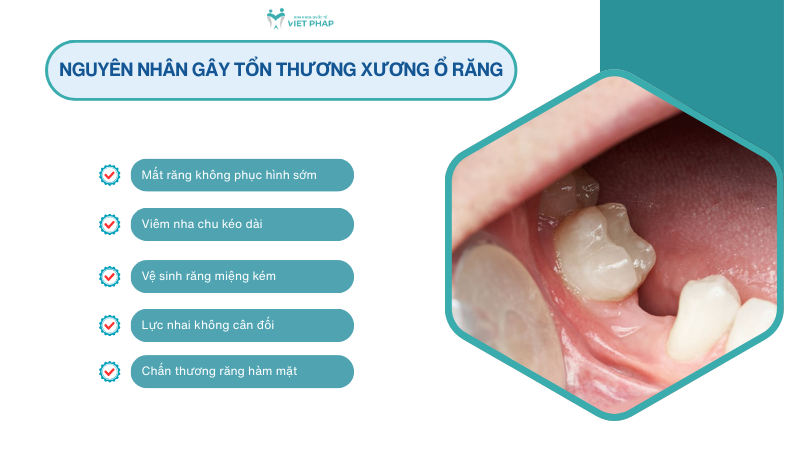 Nguyên nhân gây tổn thương xương ổ răng