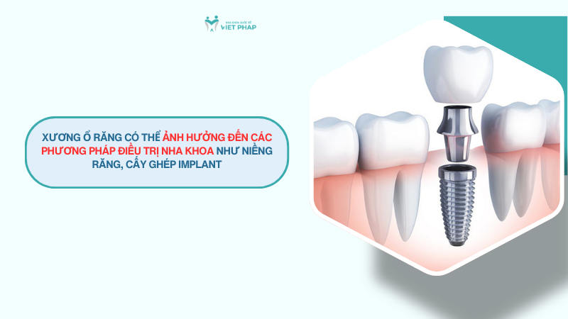 Xương ổ răng có thể ảnh hưởng đến các phương pháp điều trị nha khoa như niềng răng, cấy ghép implant