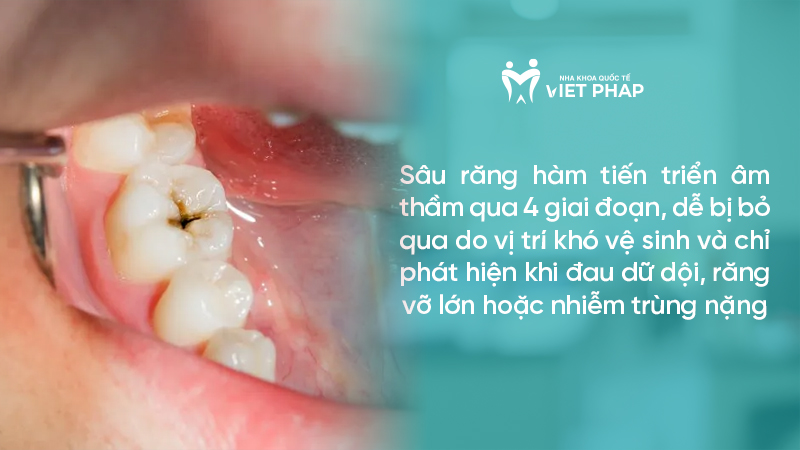 Sâu răng hàm tiến triển âm thầm qua 4 giai đoạn, dễ bị bỏ qua do vị trí khó vệ sinh và chỉ phát hiện khi đau dữ dội, răng vỡ lớn hoặc nhiễm trùng nặng