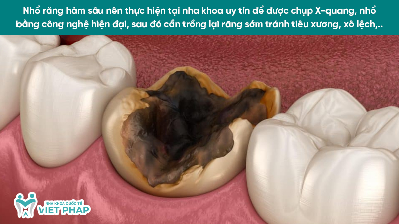 Nhổ răng hàm sâu nên thực hiện tại nha khoa uy tín để được chụp X-quang, nhổ bằng công nghệ hiện đại, sau đó cần trồng lại răng sớm tránh tiêu xương, xô lệch,..
