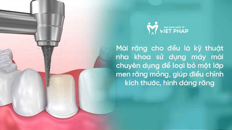 Mài răng cho đều là kỹ thuật nha khoa sử dụng máy mài chuyên dụng để loại bỏ một lớp men răng mỏng, giúp điều chỉnh kích thước, hình dáng răng