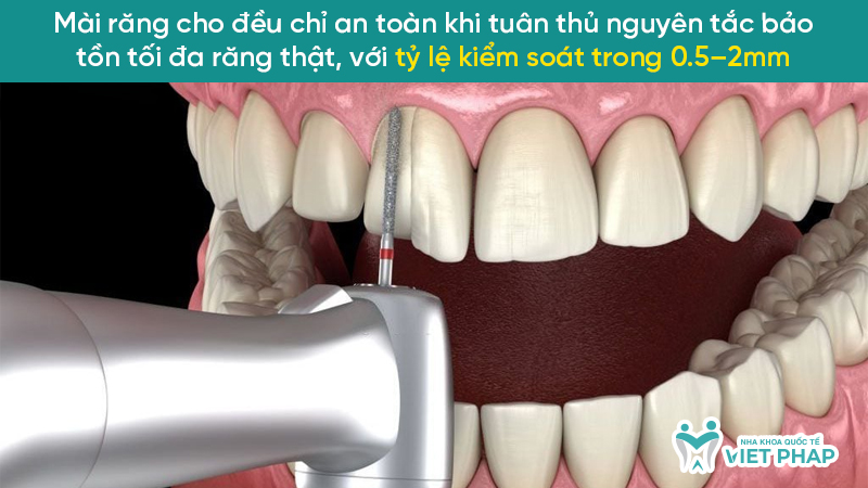 Mài răng cho đều chỉ an toàn khi tuân thủ nguyên tắc bảo tồn tối đa răng thật, với tỷ lệ kiểm soát trong 0.5–2mm