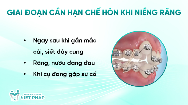 Giai đoạn cần hạn chế hôn khi niềng răng