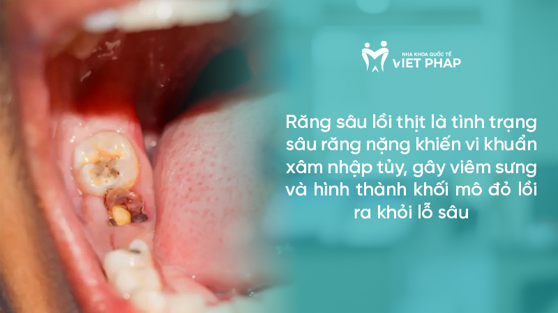 Răng sâu lồi thịt là tình trạng sâu răng nặng khiến vi khuẩn xâm nhập tủy, gây viêm sưng và hình thành khối mô đỏ lồi ra khỏi lỗ sâu
