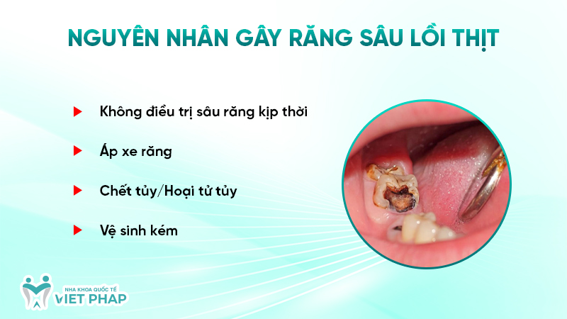 Nguyên nhân gây răng sâu lồi thịt