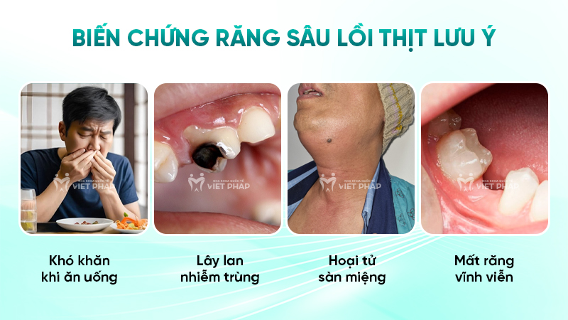 Biến chứng răng sâu lồi thịt lưu ý