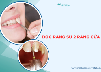 Bọc răng sứ 2 răng cửa