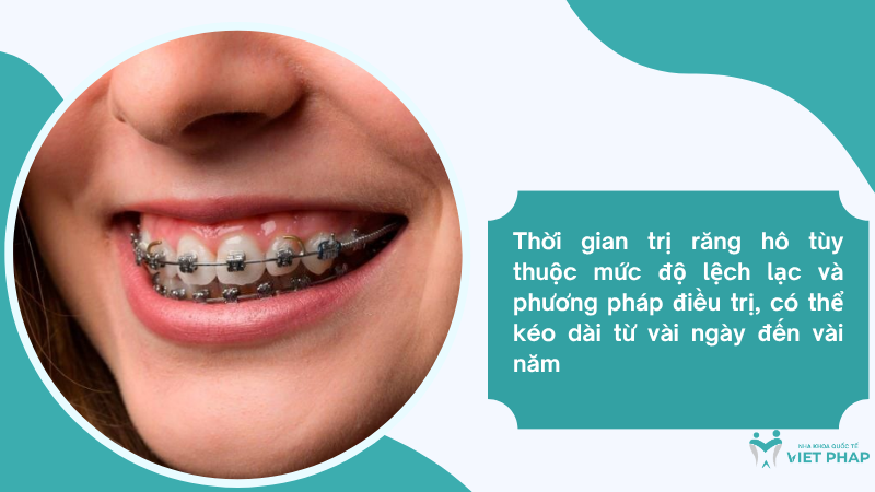 Thời gian trị răng hô tùy thuộc mức độ lệch lạc và phương pháp điều trị, có thể kéo dài từ vài ngày đến vài năm