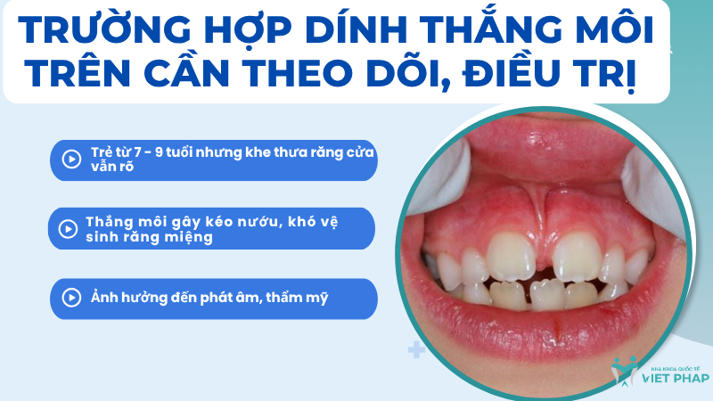 Trường hợp dính thắng môi trên cần theo dõi, điều trị