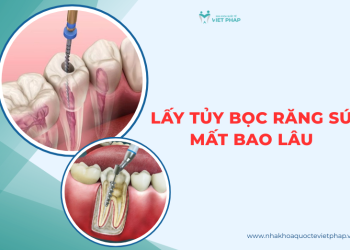 Lấy tủy bọc răng sứ mất từ 3 – 7 ngày? Chi tiết thời gian, quy trình và lưu ý cần biết