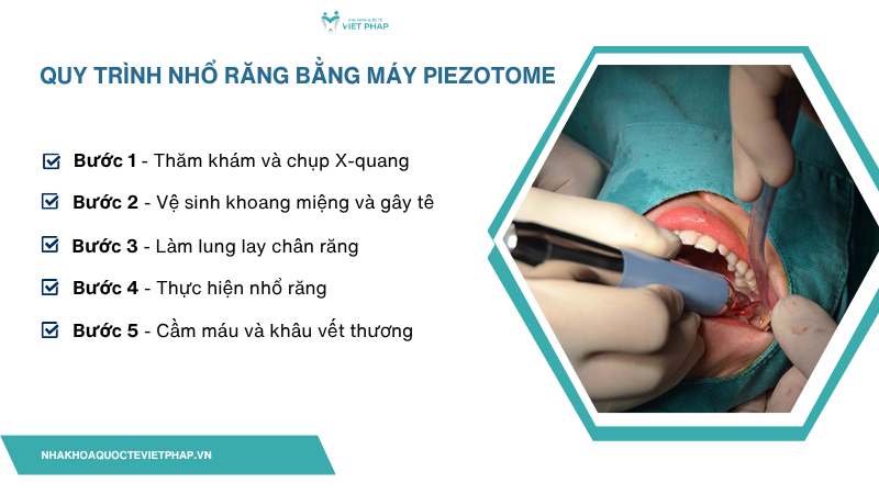 may nho rang sieu am piezotome 5 Quy trình nhổ răng bằng máy Piezotome