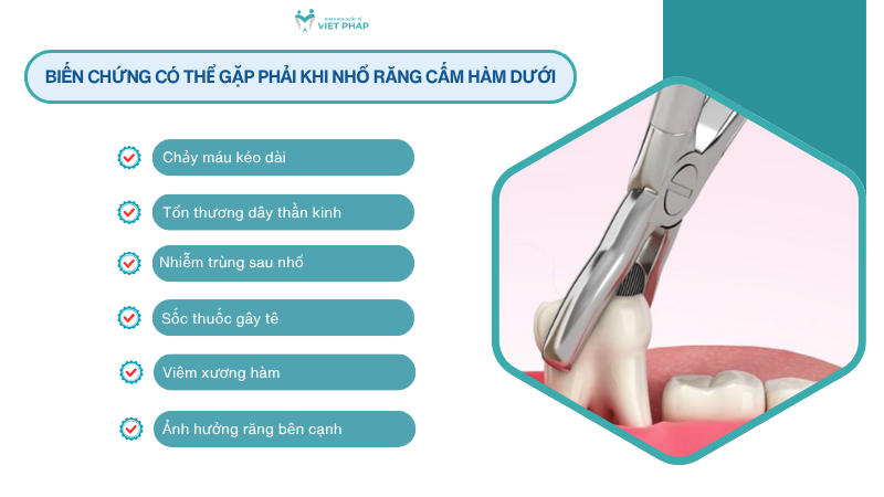 Biến chứng có thể gặp phải khi nhổ răng cấm hàm dưới