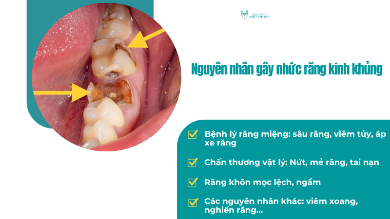 nhuc rang kinh khung phai lam sao 2 Nguyên nhân gây nhức răng kinh khủng