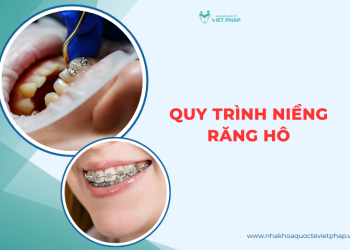 Quy trình niềng răng hô