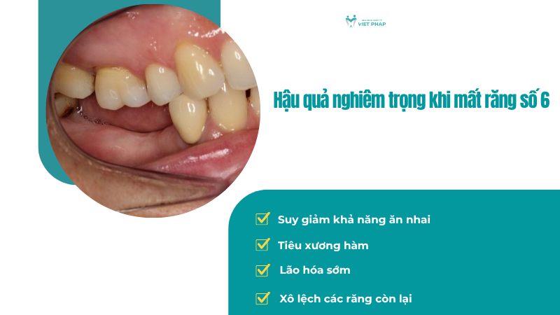 rang so 6 nho roi co moc lai khong 3 Hậu quả nghiêm trọng khi mất răng số 6