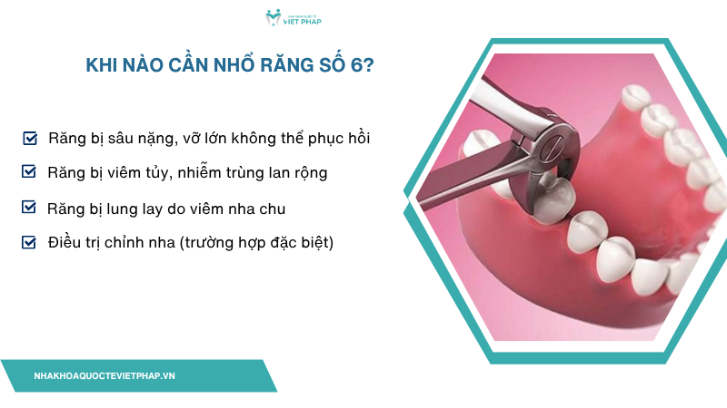 rang so 6 nho roi co moc lai khong 4 Khi nào cần nhổ răng số 6?