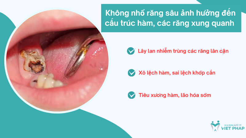 tac hai cua viec khong nho rang sau 2 Không nhổ răng sâu ảnh hưởng đến cấu trúc hàm, các răng xung quanh