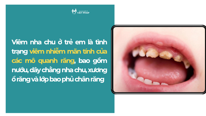 viem nha chu o tre em 1 Viêm nha chu ở trẻ em là tình trạng viêm nhiễm mãn tính của các mô quanh răng, bao gồm nướu, dây chằng nha chu, xương ổ răng và lớp bao phủ chân răng