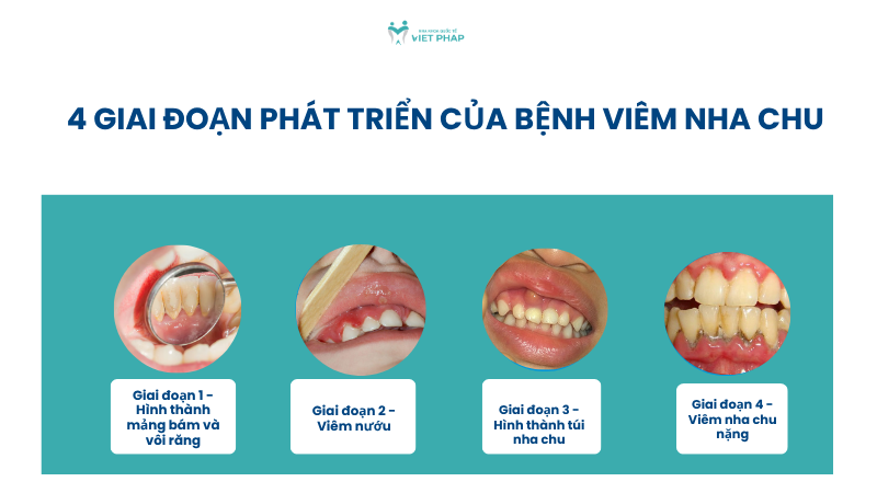 viem nha chu o tre em 2 4 giai đoạn phát triển của bệnh viêm nha chu