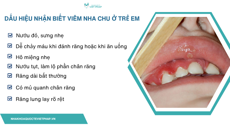 viem nha chu o tre em 4 Dấu hiệu nhận biết viêm nha chu ở trẻ em