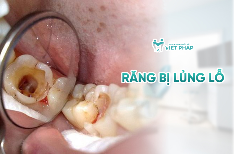 Răng bị lủng lỗ phải làm sao? Triệu chứng, xử lý và phòng ngừa hiệu quả
