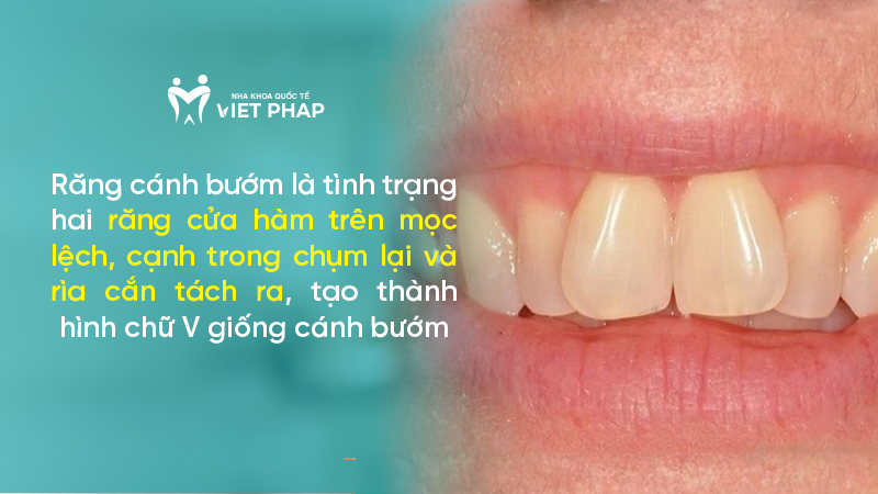 Răng cánh bướm là tình trạng hai răng cửa hàm trên mọc lệch, cạnh trong chụm lại và rìa cắn tách ra, tạo thành hình chữ V giống cánh bướm