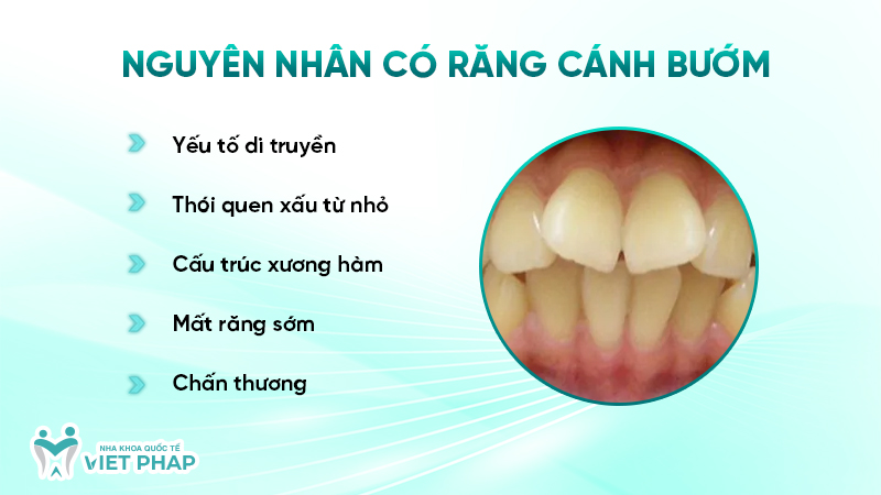 Nguyên nhân có răng cánh bướm