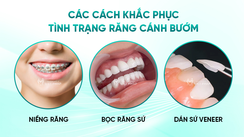 Các cách khắc phục tình trạng răng cánh bướm