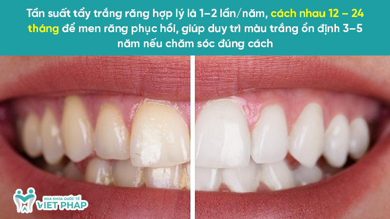 Tần suất tẩy trắng răng hợp lý là 1–2 lần/năm, cách nhau 12 – 24 tháng để men răng phục hồi, giúp duy trì màu trắng ổn định 3–5 năm nếu chăm sóc đúng cách