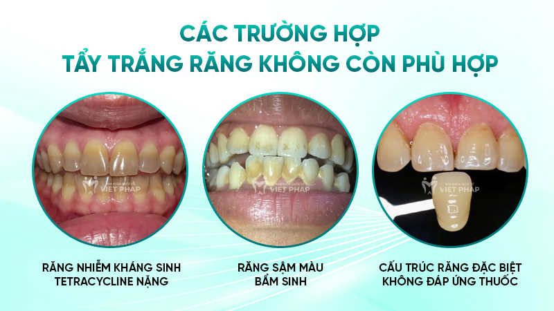 Các trường hợp tẩy trắng răng không còn phù hợp
