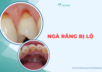 Ngà răng bị lộ
