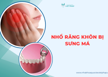 Nhổ răng khôn bị sưng má