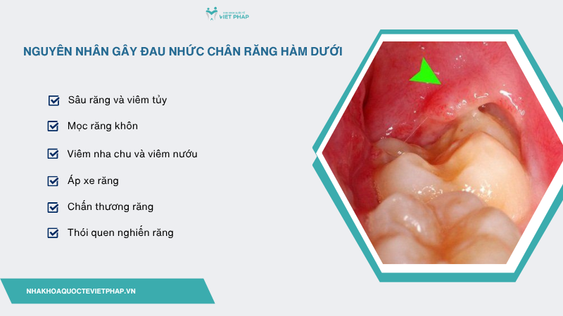 nhuc chan rang ham duoi 2 Nguyên nhân gây đau nhức chân răng hàm dưới