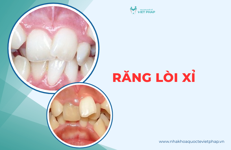 Răng lòi xỉ