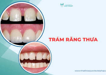 [Hỏi đáp] Có nên trám răng thưa? Các vật liệu trám và chi phí từ 300.000 VNĐ/ răng 