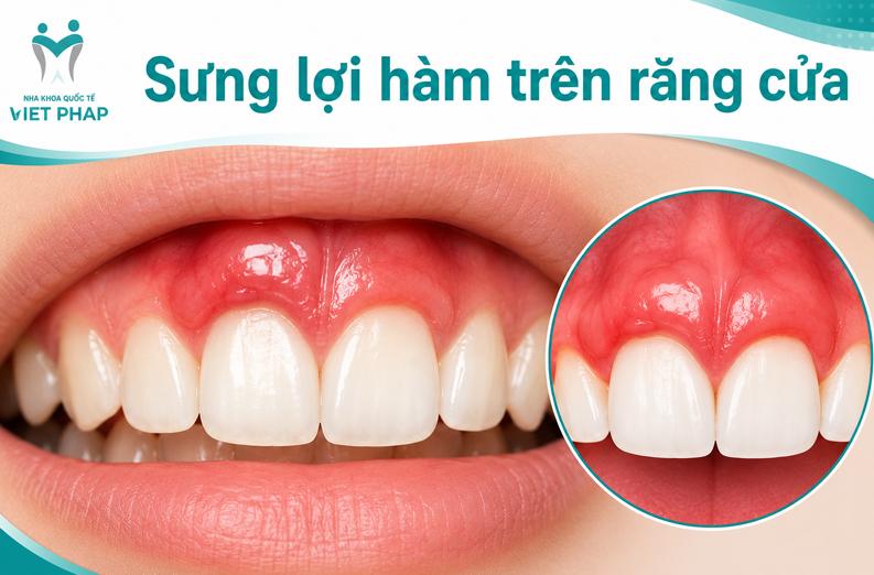 Tôi bị Sưng lợi hàm trên răng cửa đau nhức? Nguyên nhân, cách điều trị và phòng ngừa