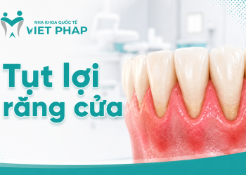 Tôi bị tụt lợi răng cửa phải làm sao? Biến chứng, cách điều trị và phòng ngừa hiệu quả