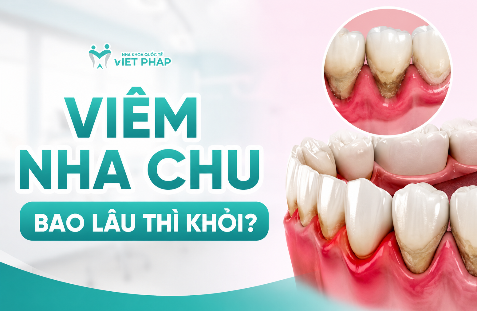 Viêm nha chu bao lâu thì khỏi