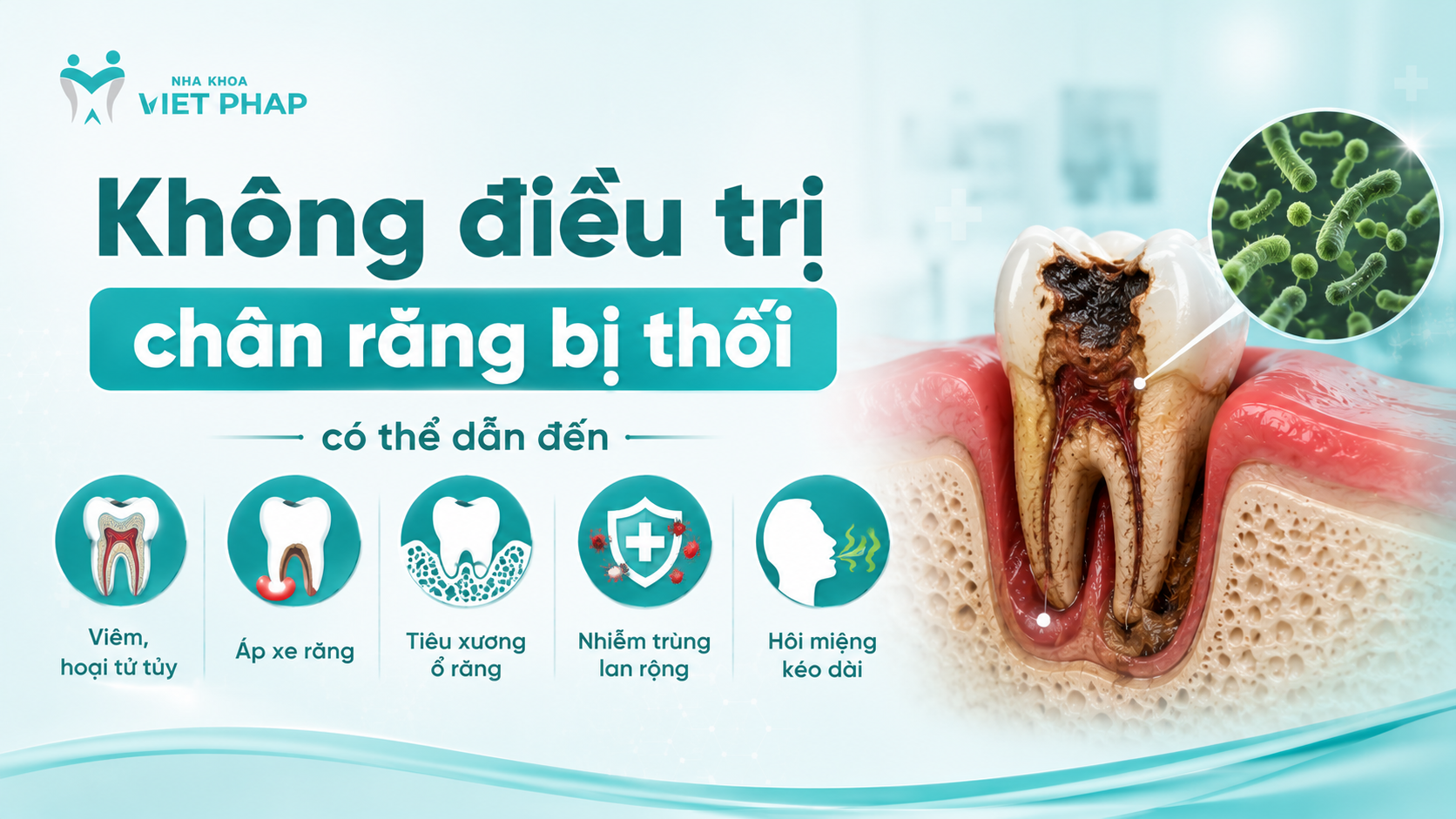 Không điều trị chân răng bị thối có thể dẫn đến viêm, hoại tử tủy; áp xe răng; tiêu xương ổ răng, nhiễm trùng lan rộng và hôi miệng kéo dài