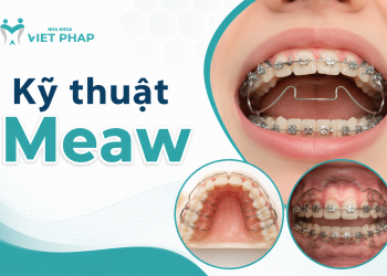Kỹ thuật Meaw