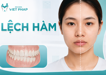 Lệch hàm